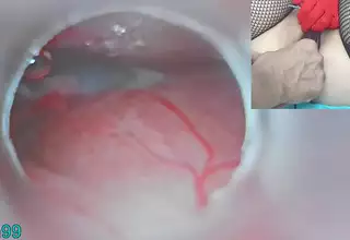 Japanese Insemination with Cum into Uterus and Endoscope Camera by Cervix to watch inside womb Uncensored